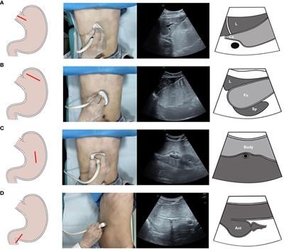 Risk stratification of gastric cancer screening in community population based on oral contrast-enhanced ultrasonography examination: A 3-year follow-up analysis report